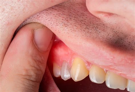 tooth abscess jaw lump  elenora spink blog
