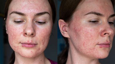 What is Papulopustular Rosacea? – GLOWBIOTICS