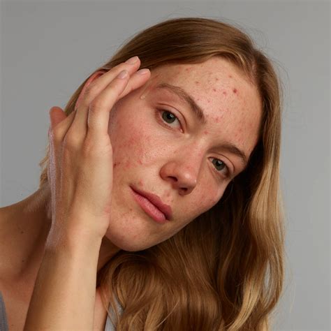 Effektive Gesichtsreinigung bei Akne | Gladskin