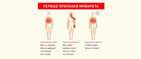 Признаки инфаркта у женщин старше 50 - 55 лет