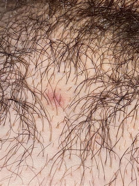 Genital wart scarring : r/DermatologyQuestions