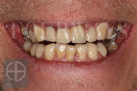 Porcelain Veneers & Smile Design - Gallery — Fourways Dental Clinic
