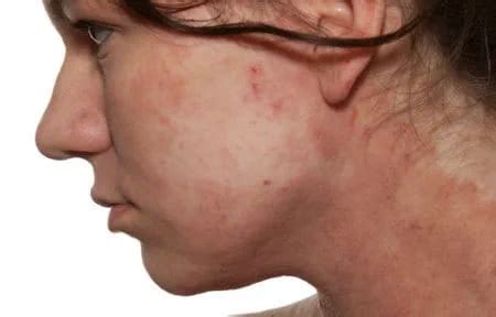 dermatitis  face  signs symptoms eucerin