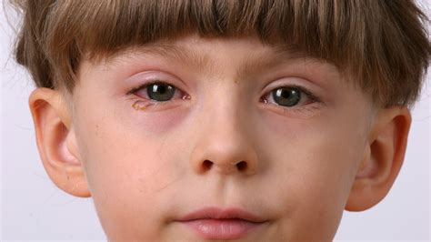 pink eye  symptoms  treatment goodrx