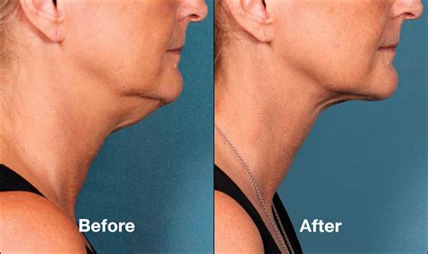 BELKYRA® (KYBELLA) in London, Ontario | DermEffects