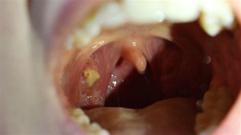 Cancer White Spots On Tonsils - Printable Templates Free