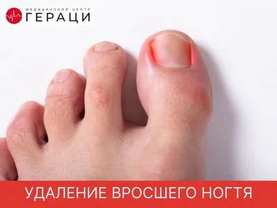76+ Утолщение ногтя на ноге фото