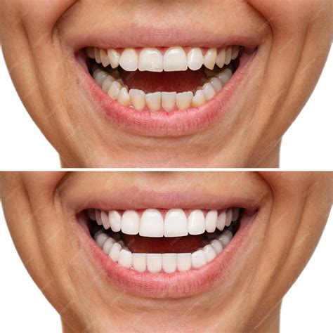 Teeth Veneers Before And After