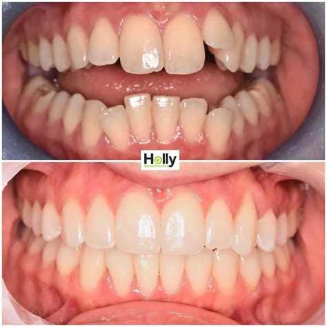 High Canine Teeth Before And After Braces at Joseph Larrick blog