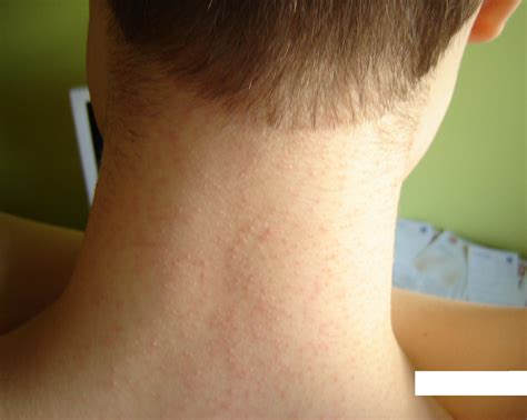 Pityrosporum Folliculitis Chest