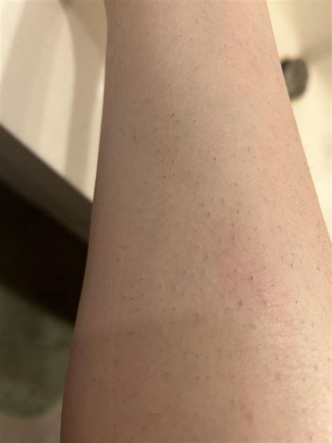 Why do my legs look like this after epilating? : TheGirlSurvivalGuide