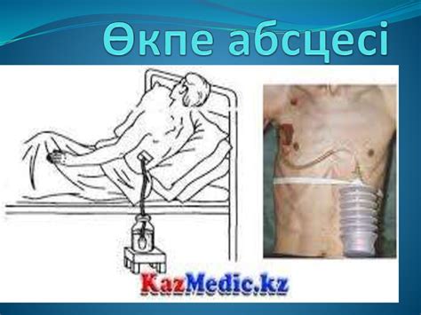 Өкпе абсцесі - презентация онлайн
