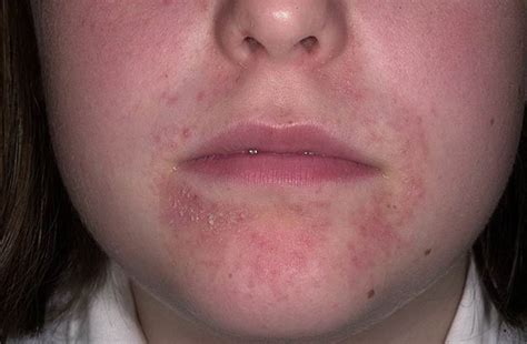 Dermatitis On Your Face at Nettie Cox blog