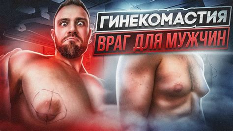 ГИНЕКОМАСТИЯ у мужчин. Лечить или оперировать? Причины и симптомы ...