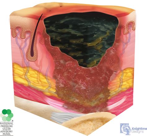 unstageable pressure injurydark eschar illustrations  figure