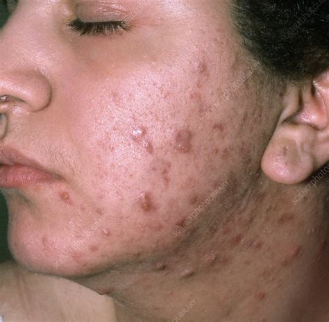 Acne vulgaris - Stock Image - C059/5083 - Science Photo Library