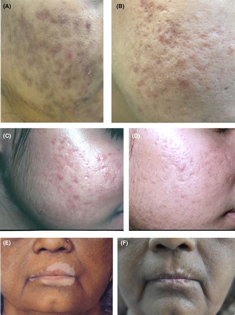 “Chemical Peel Recipe”—An easy and quick method of peel preparation in ...
