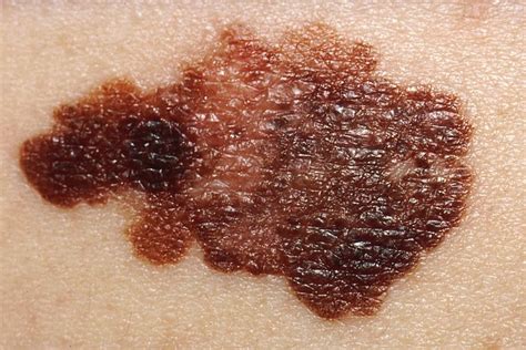How to Get Rid of Discoloration of Skin