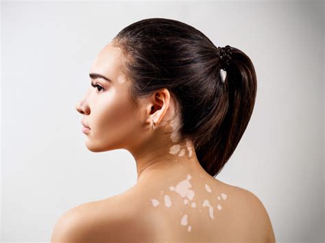 Vitiligo Overview: Types, Causes, Symptoms, and Treatment | Pfizer