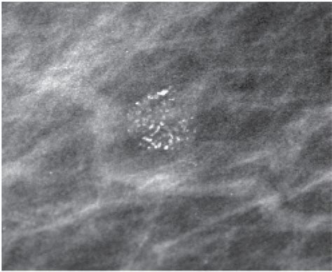 Breast Calcifications | Radiology Key