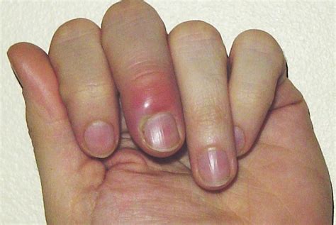 paronychia   treatment   infected nail
