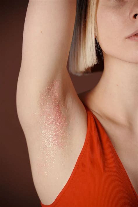 Hidradenitis Suppurutiva - Nordic Bioscience