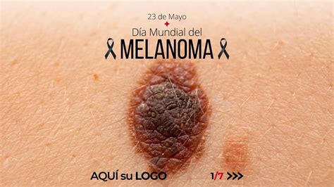 Día Mundial del Melanoma - YouTube