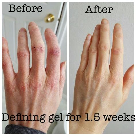 How to treat dyshidrotic eczema 8 effective home remedies – Artofit