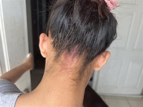 Scalp rash : r/ScalpPsoriasis