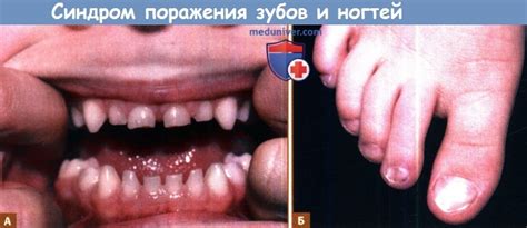 Синдром поражения зубов и ногтей (синдром Уиткопа, гиподонтия с ...