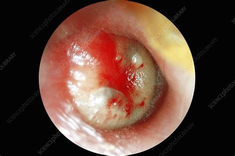 Ear infection, otoscope view - Stock Image - C026/1040 - Science Photo ...