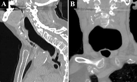 ct scan   neck  lateral   anteriorposterior