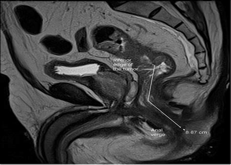 Anal Verge Mri