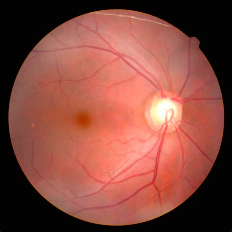 primary  secondary angle closure glaucoma viewpoint