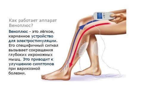 Аппарат "Веноплюс"