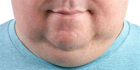 How to Get Rid of Double Chin | Causes and Treatments