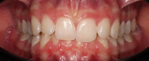Клинические случаи по лечению ретрузии элайнерами Star Smile