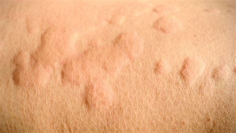 Common Causes Of Itchy Red Bumps On Skin | The Best Porn Website