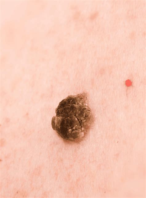 Seborrhoeic Keratosis | Thomson Medical