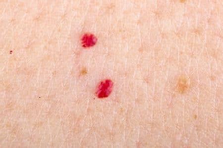 Красные точки на теле: Панкреатит и симптом Тужилина | Red moles, Skin ...