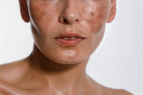 Symptoms of Chromhidrosis: Hines Dermatology Associates Inc.: Dermatology
