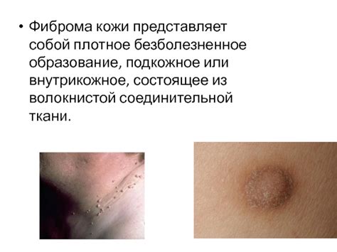 Истинная Фиброма, Фибросаркома презентация, доклад