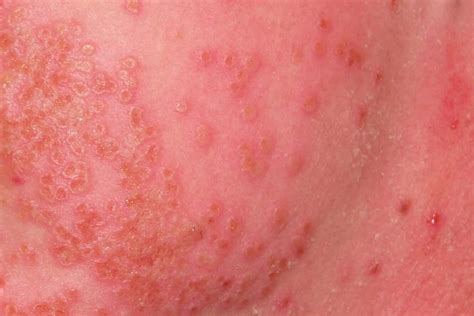 8 Different Types of Eczema - Pure Medical