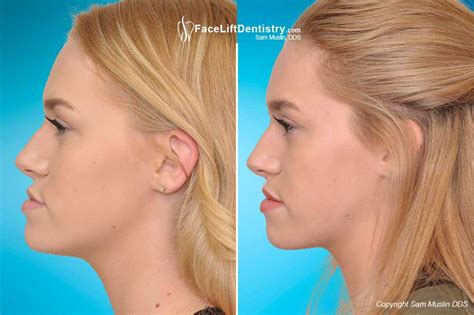 The Ideal Jaw Position with JawTrac Technology