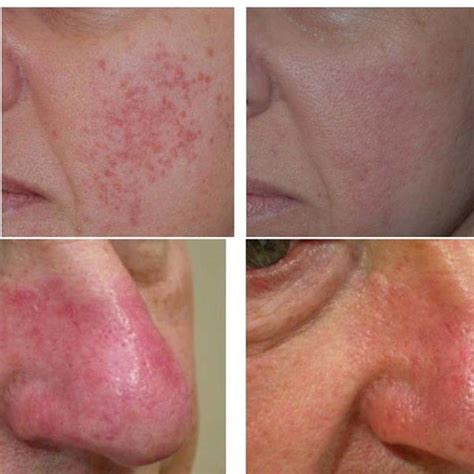 Phymatous Rosacea Symptoms » Rhinoplasty: Cost, Pics, Reviews, Q&A