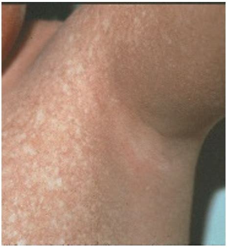 Figure 1. [Post-inflammatory poikiloderma in a boy age ten years; note ...