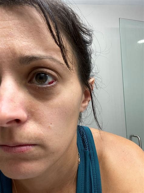 how to heal broken blood vessel in eye fast 12
