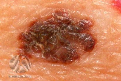 skin cancer symptoms  treatment  dermatology skin surgery