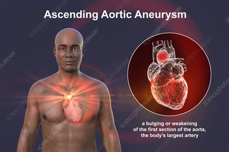Ascending aortic aneurysm, illustration - Stock Image - F038/1076 ...
