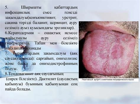Реактивті артрит - презентация онлайн